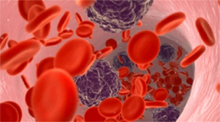 Haematological Malignancies